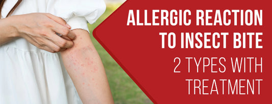 Allergic Reaction to Insect Bite: 2 Types With Treatment