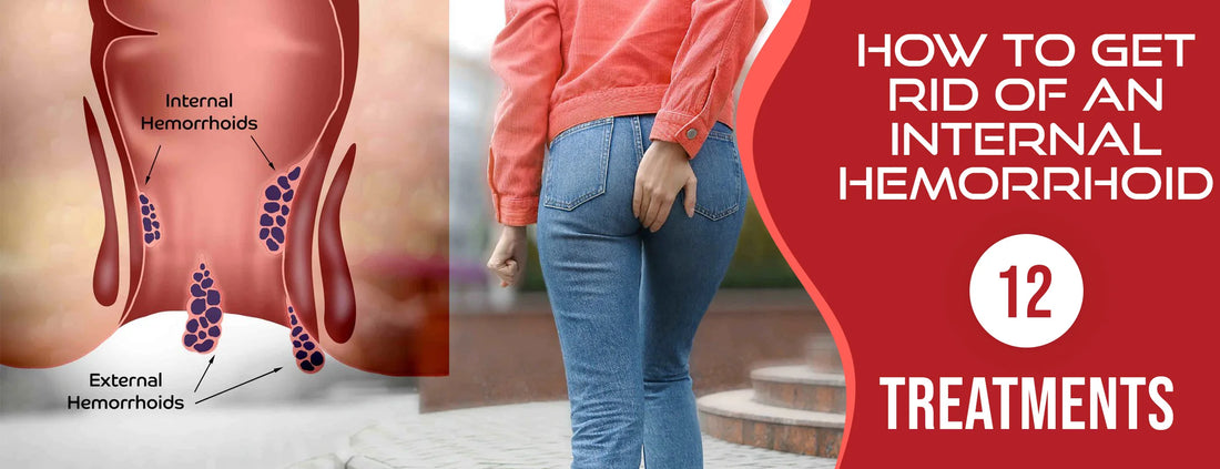 How To Get Rid Of An Internal Hemorrhoid: 12 Treatments