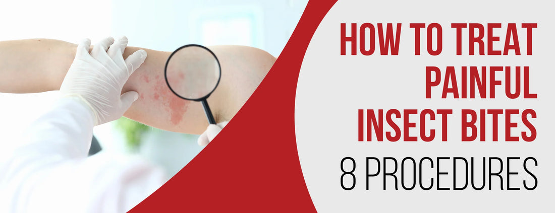 How To Treat Painful Insect Bites: 8 Procedures