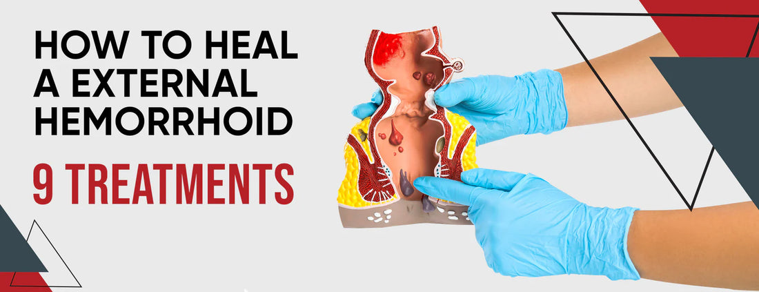 How to Heal A External Hemorrhoid: 9 Treatments