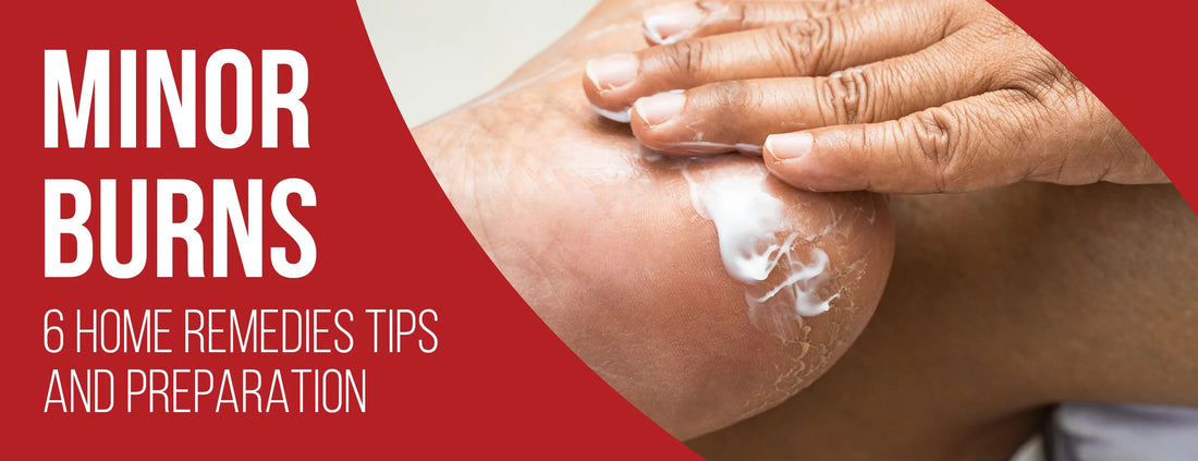 Minor Burns: 6 Home Remedies Tips & Preparation
