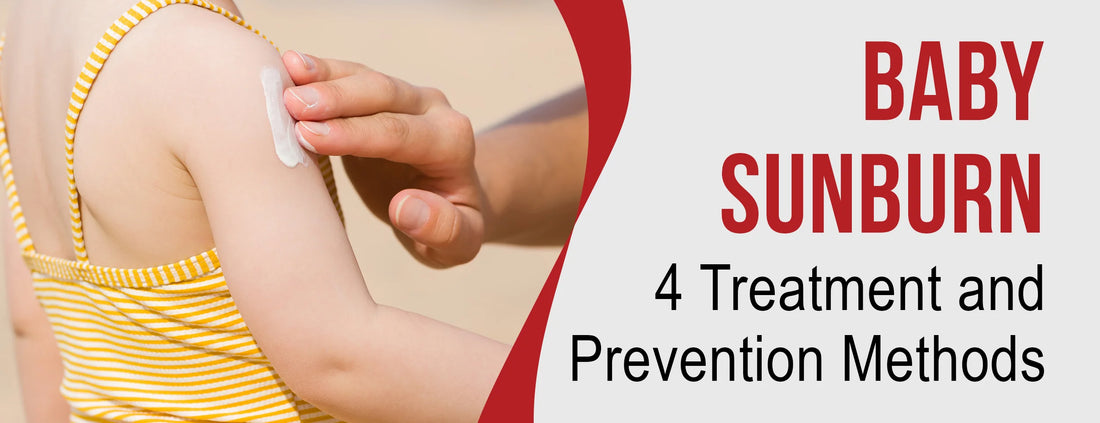 Baby Sunburn: 4 Treatment & Prevention Methods