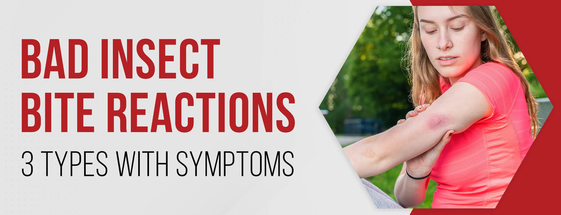 Bad Insect Bite Reactions: 3 Types [With Symptoms]