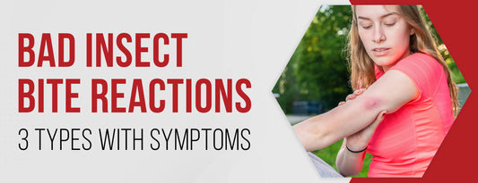 Bad Insect Bite Reactions: 3 Types [With Symptoms]