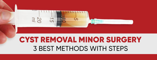 Cyst Removal Minor Surgery: 3 Best Methods [With Steps]
