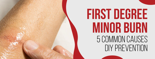 First Degree Minor Burn: 5 Common Causes [DIY Prevention]
