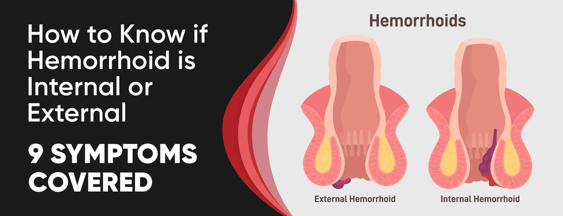 How to Know if Hemorrhoid is Internal or External: 9 Symptoms [Covered]