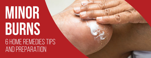 Minor Burns: 6 Home Remedies Tips & Preparation