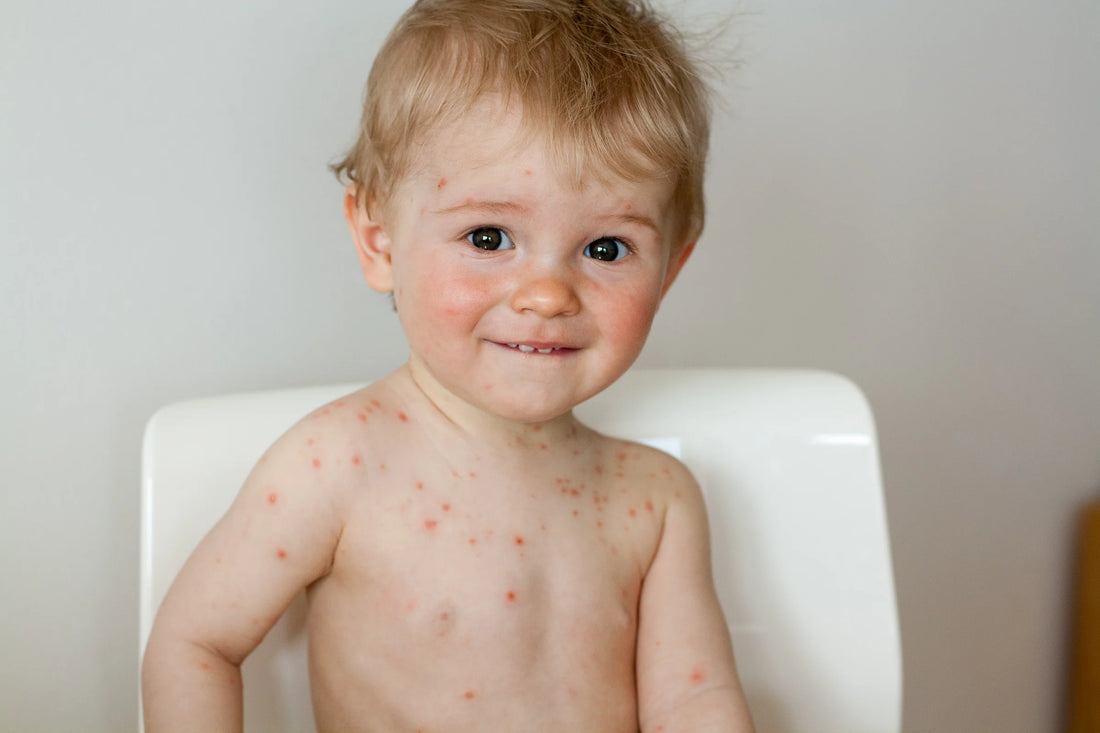 Natural Immunity to Chicken Pox: Development [3 Factors]