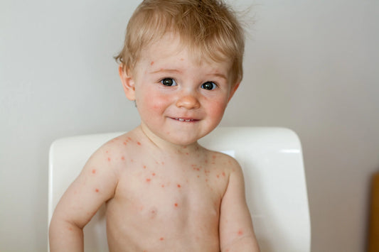 Natural Immunity to Chicken Pox: Development [3 Factors]